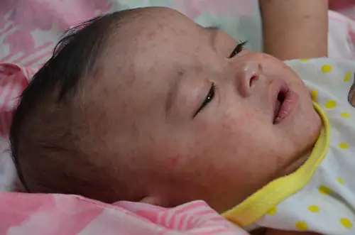 4 Dead From Measles in PA While RFK Jr. Calls Deaths 'Fabricated'