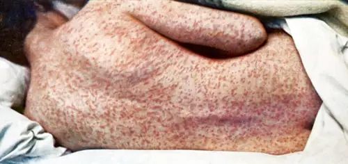 Measles Train Tour Hits Six CA Counties While RFK Jr. Cheers Anti-Vaxxers