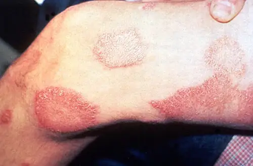 Leprosy Is Making a Comeback in Florida and Armadillos Are Suspects