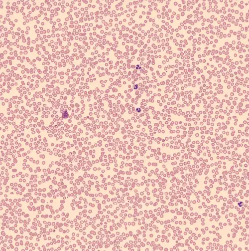Man Finds Four Blood Clots After AI Catches What His Chiropractor Missed