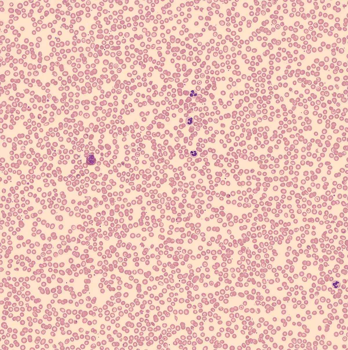 Howell-Jolly bodies (Overview of peripheral blood stain, May-Grünwald Giemsa)