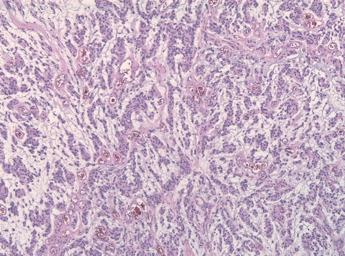 Adenoid glioblastoma HE
