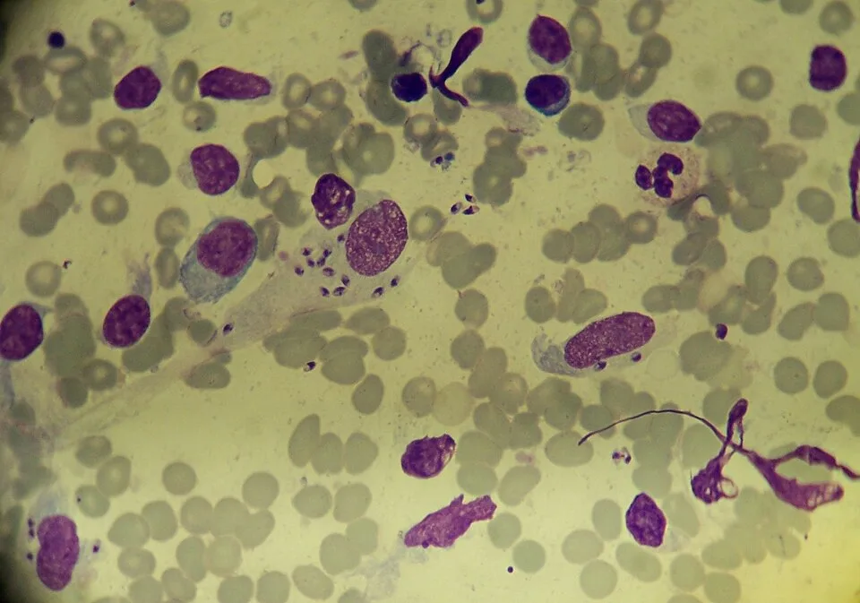Extracellular and intracellular leishmania parasites in a patient with cutaneous leishmaniasis